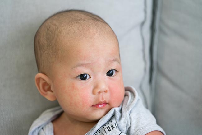 ผื่นคัน ผื่นคัน