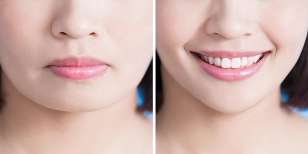 เสริมคาง เสริมคาง