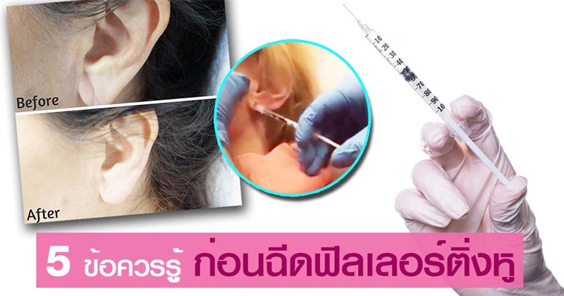 ฉีดฟิลเลอร์ ฉีดฟิลเลอร์