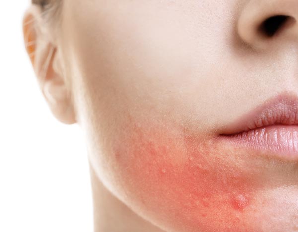วิธีรักษาผื่นแพ้บนใบหน้า วิธีรักษาผื่นแพ้บนใบหน้า