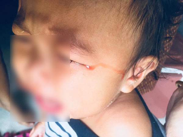 เตือนภัยพ่อแม่ ลูกเล่นมือถือจนน้ำตาไหลเป็นเลือด เตือนภัยพ่อแม่ ลูกเล่นมือถือจนน้ำตาไหลเป็นเลือด