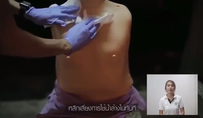 วิธีปฐมพยาบาลเมื่อถูกสาดน้ำกรด วิธีปฐมพยาบาลเมื่อถูกสาดน้ำกรด