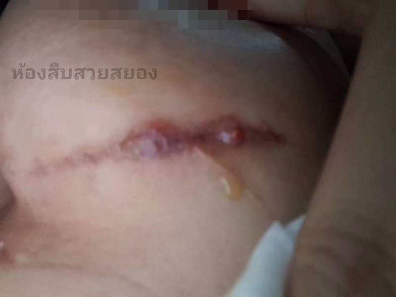 ศัลยกรรมหน้าอกทำพิษ ศัลยกรรมหน้าอกทำพิษ