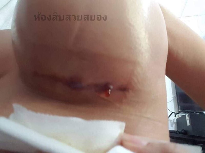 ศัลยกรรมหน้าอกทำพิษ ศัลยกรรมหน้าอกทำพิษ