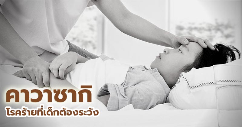 โรคคาวาซากิ โรคคาวาซากิ