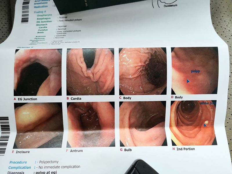 ลำไส้อักเสบ ลำไส้อักเสบ