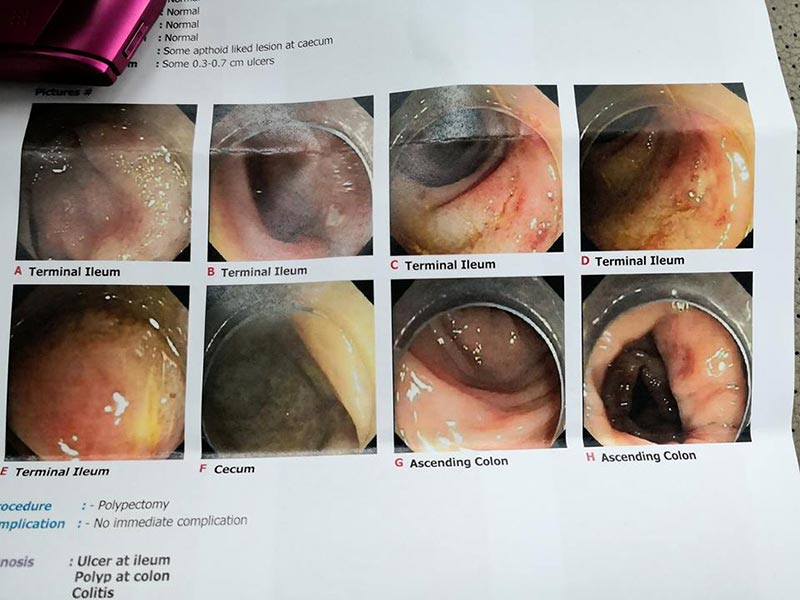 ลำไส้อักเสบ ลำไส้อักเสบ