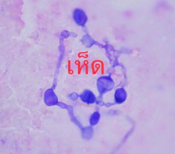 ติดเชื้อสปอร์เห็ด ติดเชื้อสปอร์เห็ด