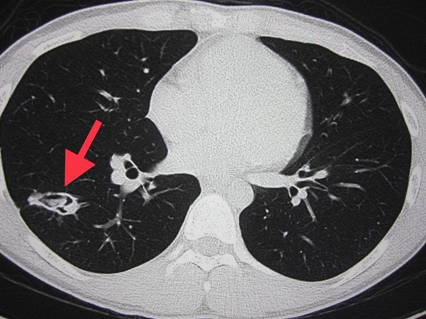 ติดเชื้อสปอร์เห็ด ติดเชื้อสปอร์เห็ด
