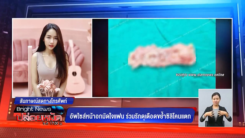 เสริมนม เสริมนม