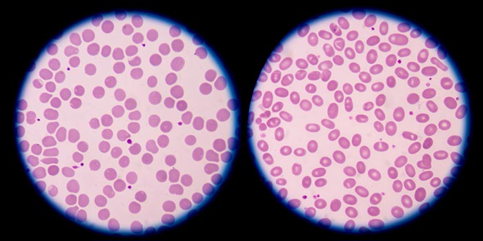 โรค Hereditary Ovalocytosis โรค Hereditary Ovalocytosis