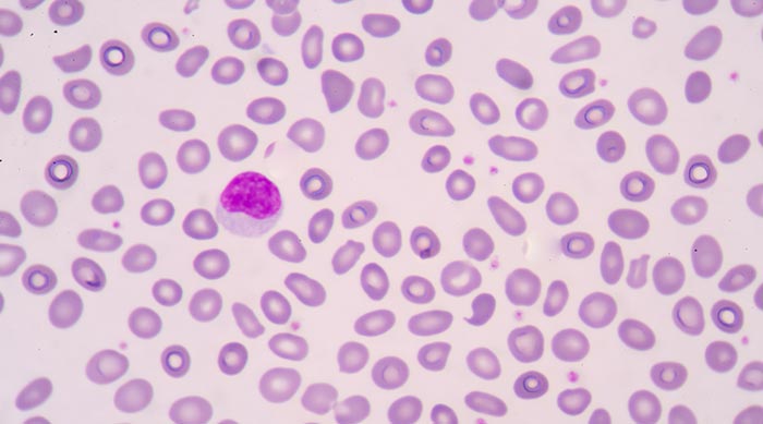 โรค Hereditary Ovalocytosis โรค Hereditary Ovalocytosis