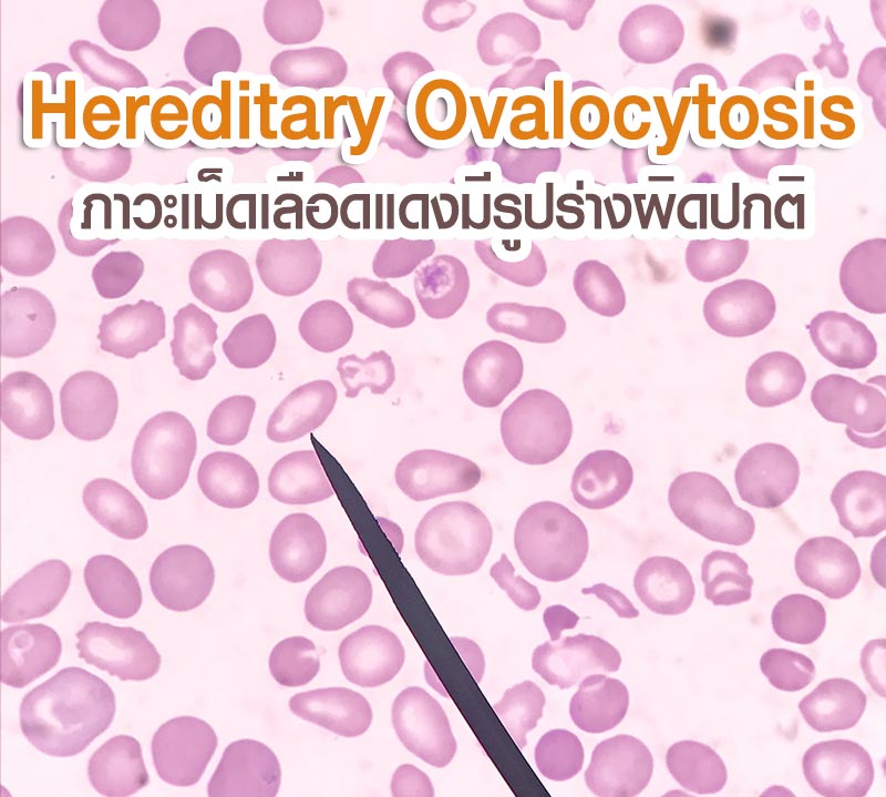 โรค Hereditary Ovalocytosis โรค Hereditary Ovalocytosis