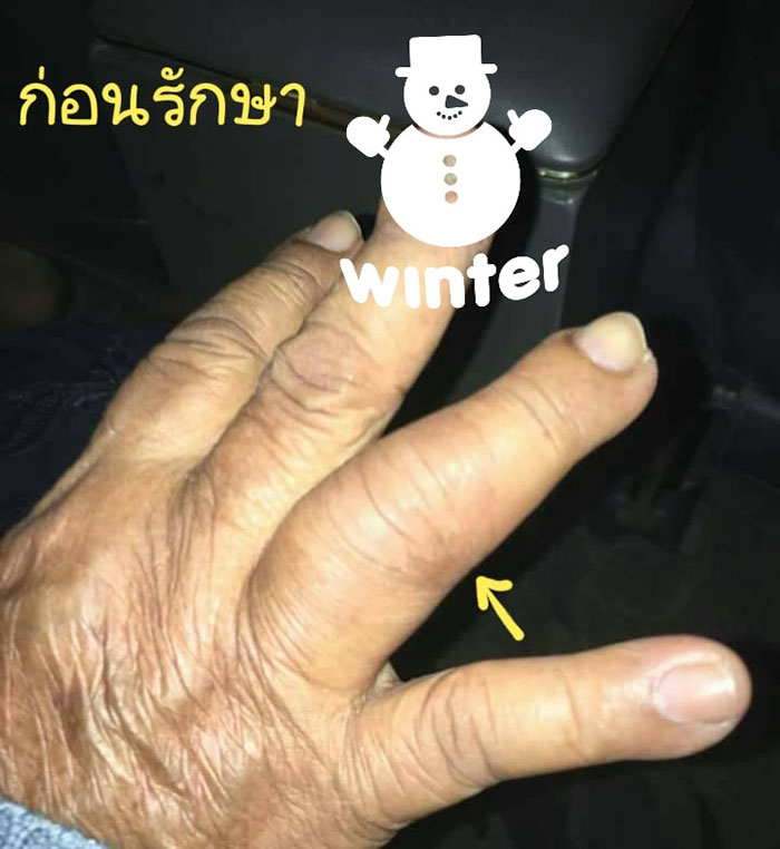 วัณโรคกระดูกนิ้วมือ วัณโรคกระดูกนิ้วมือ