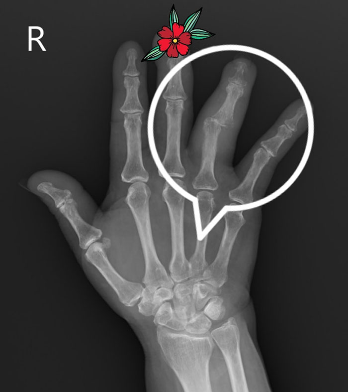 วัณโรคกระดูกนิ้วมือ วัณโรคกระดูกนิ้วมือ