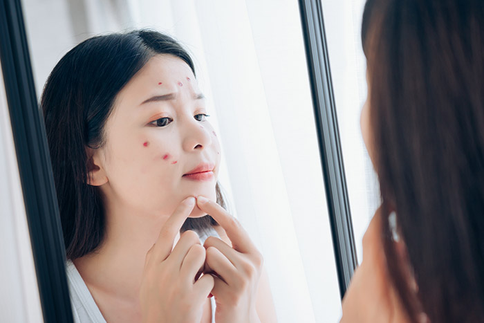 วิธีรักษาสิว วิธีรักษาสิว