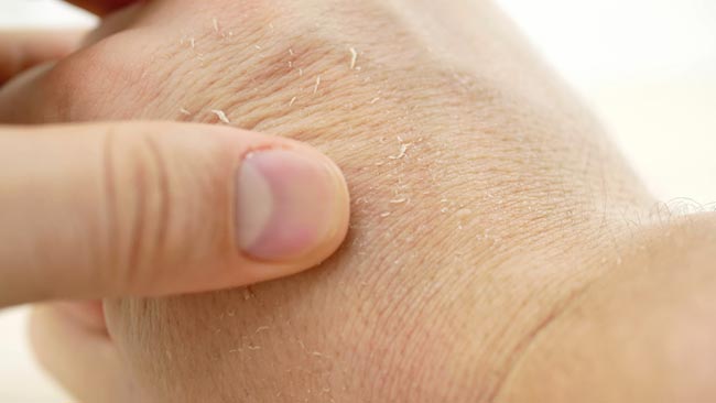 ผิวแห้ง ผิวแห้ง