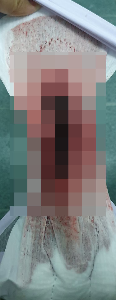 เดอร์มอยด์ ซีสต์ เดอร์มอยด์ ซีสต์