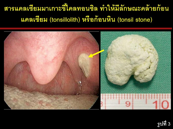 ขี้ทอนซิล ขี้ทอนซิล