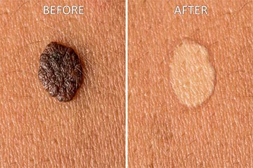 ติ่งเนื้อ ติ่งเนื้อ