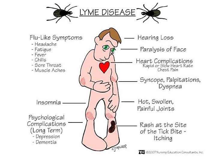 โรคลายม์ Lyme  โรคลายม์ Lyme
