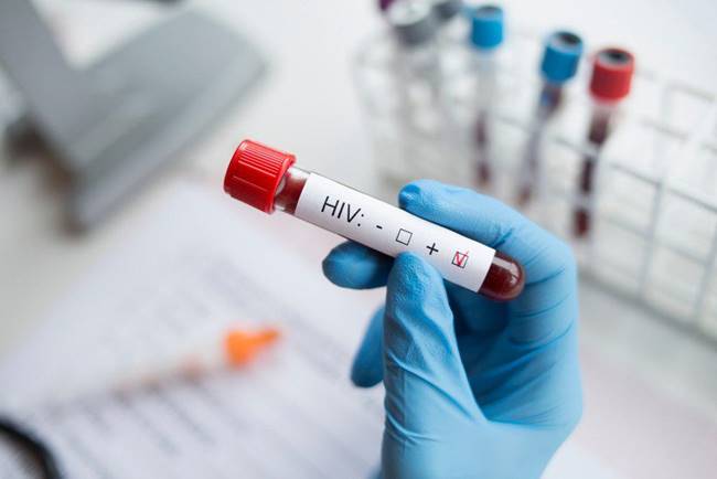 เชื้อ HIV เชื้อ HIV