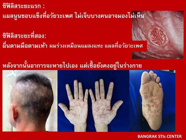 โรคซิฟิลิส โรคซิฟิลิส