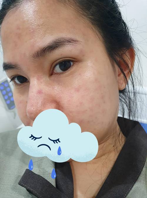 โรคสครับไทฟัส โรคสครับไทฟัส