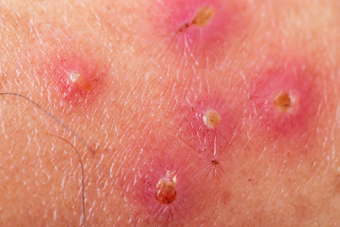 โรคผิวหนังอักเสบติดเชื้อ โรคแผลพุพอง (Impetigo)
