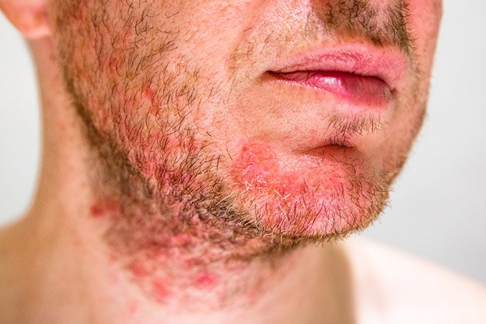 โรคผิวหนังอักเสบติดเชื้อ รูขุมขนอักเสบ (Folliculitis)