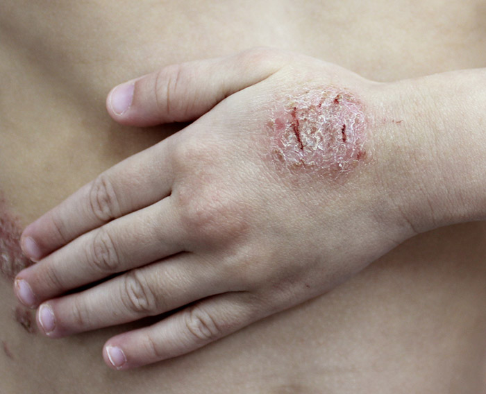 โรคผิวหนังอักเสบติดเชื้อ ผื่นผิวหนังอักเสบรูปเหรียญ (Nummular Eczema)