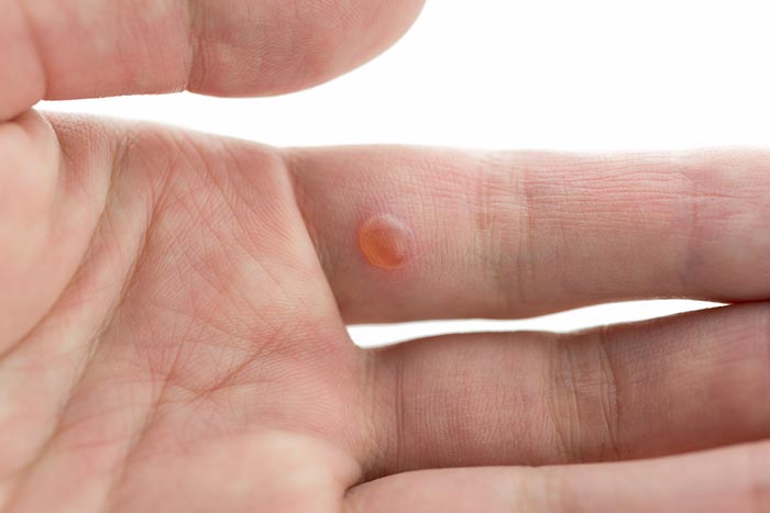 โรคผิวหนังอักเสบติดเชื้อ หูด (Warts)