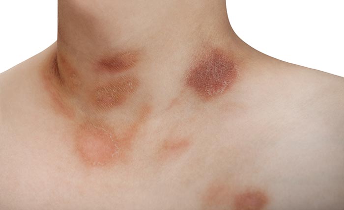 โรคผิวหนังอักเสบติดเชื้อ ผื่นกุหลาบ (Pityriasis Rosea)