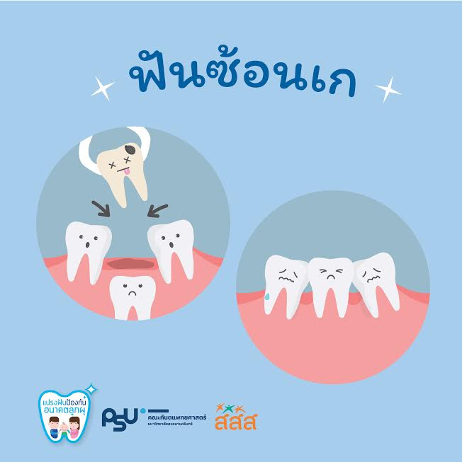 เรื่องที่ลูกอาจเจอ หากฟันน้ำนมผุ เรื่องที่ลูกอาจเจอ หากฟันน้ำนมผุ