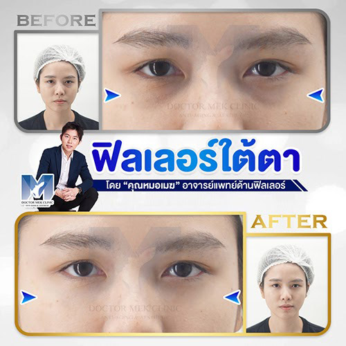 ฉีดฟิลเลอร์ ฉีดฟิลเลอร์