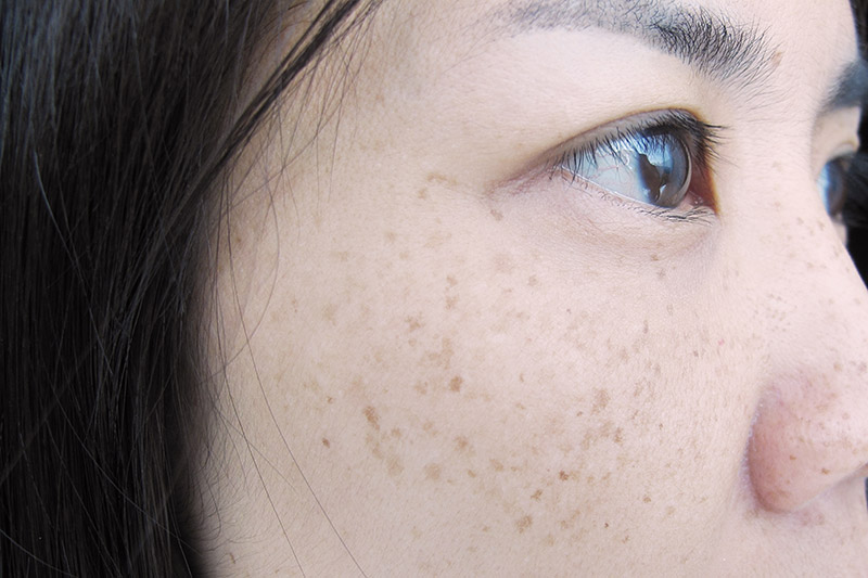 วิธีรักษากระ วิธีรักษากระ