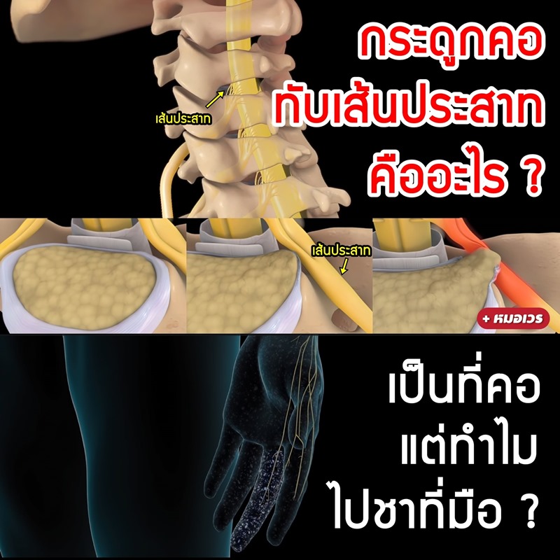 กระดูกคอทับเส้นประสาท กระดูกคอทับเส้นประสาท