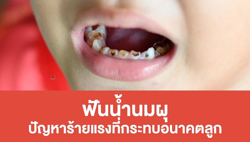 ฟันผุ ฟันผุ
