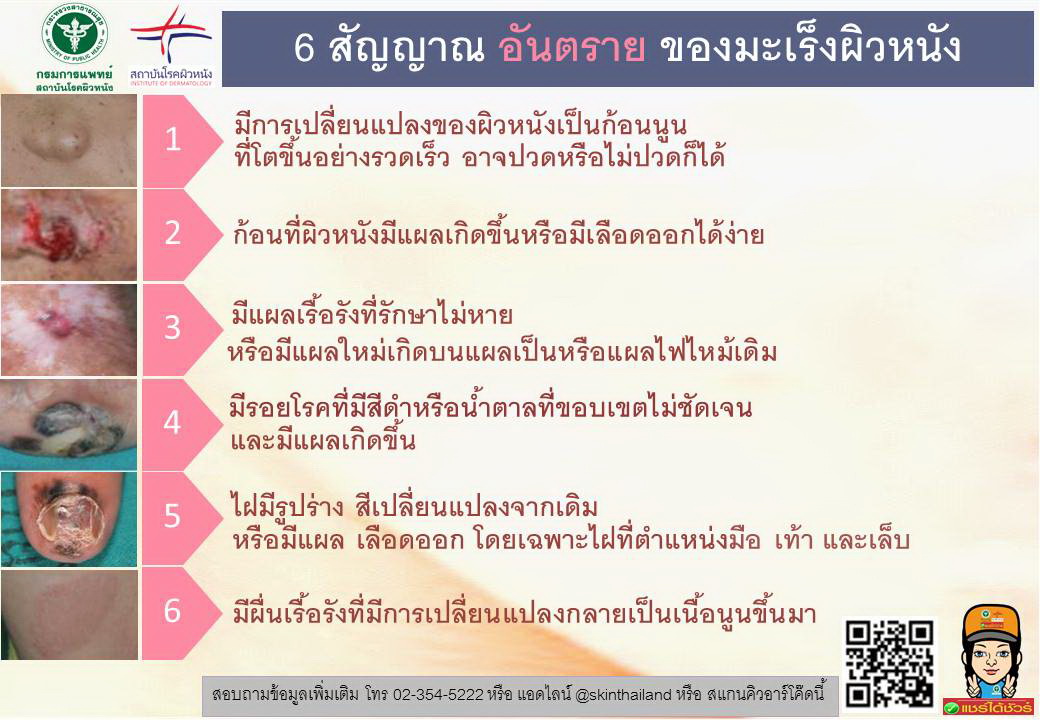 มะเร็งผิวหนัง มะเร็งผิวหนัง
