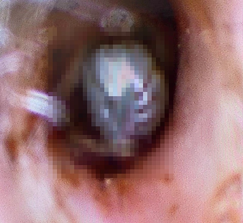 เห็บ เห็บ