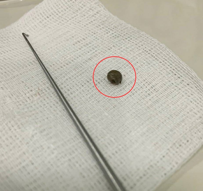 เห็บ เห็บ