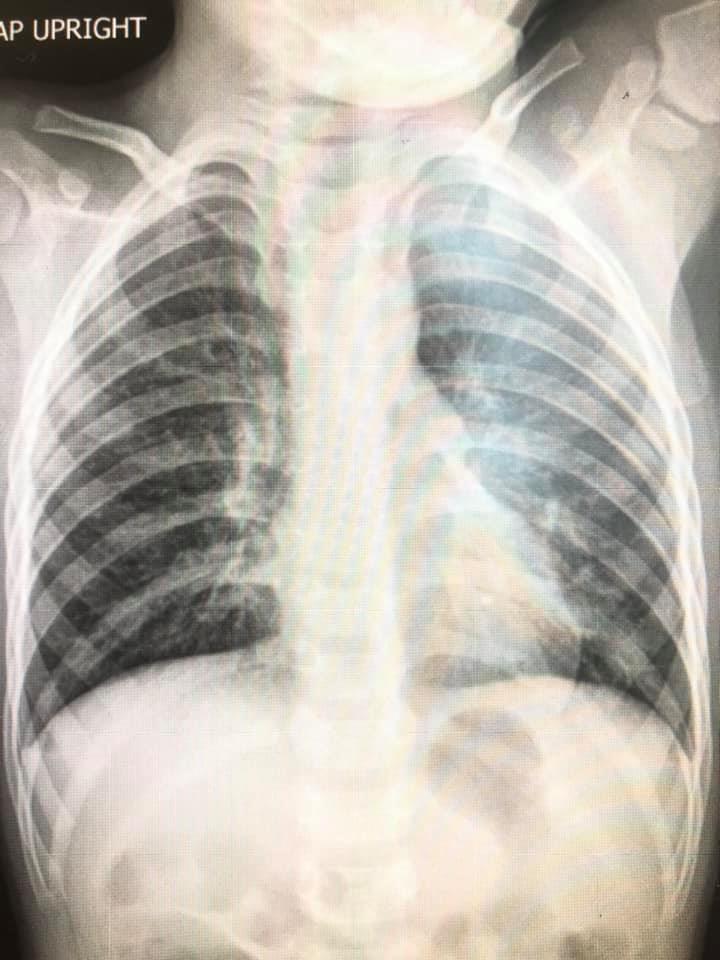 เด็กป่วย RSV เด็กป่วย RSV