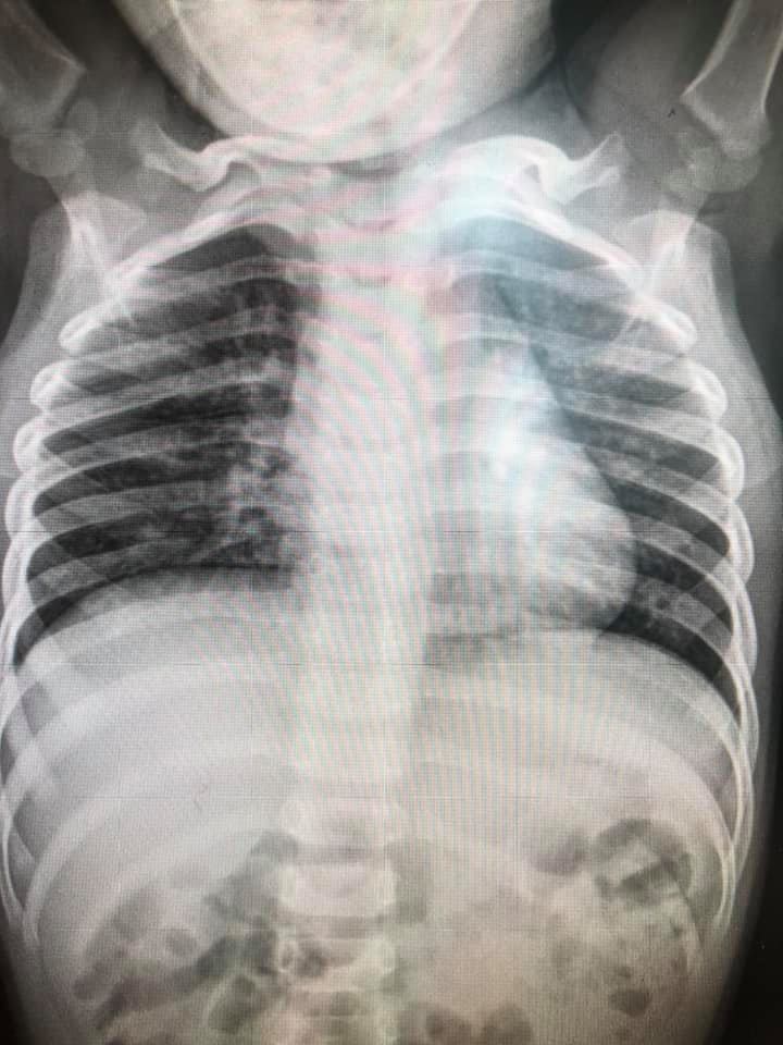 เด็กป่วย RSV เด็กป่วย RSV