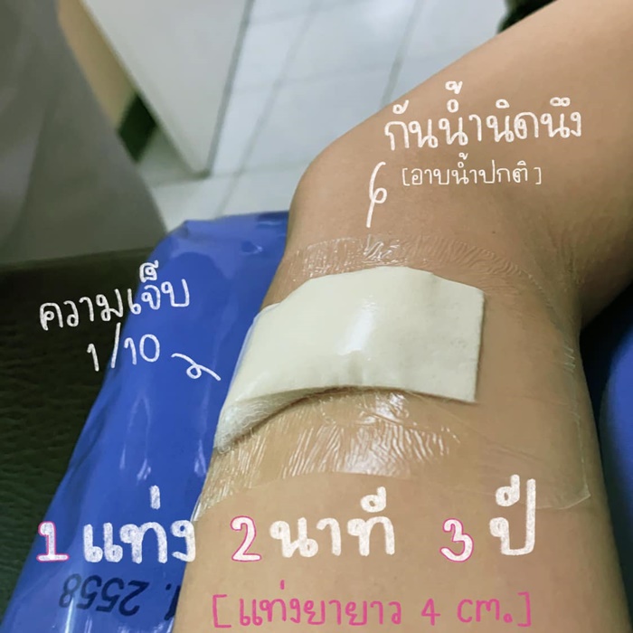 สาวแชร์ประสบการณ์ รีวิวฝังยาคุม สาวแชร์ประสบการณ์ รีวิวฝังยาคุม