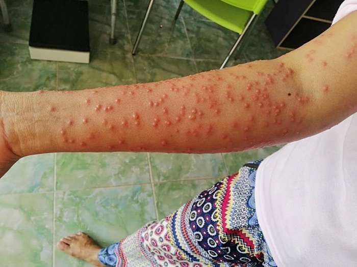 โรคหอยคัน ระบาดหนัก  โรคหอยคัน ระบาดหนัก
