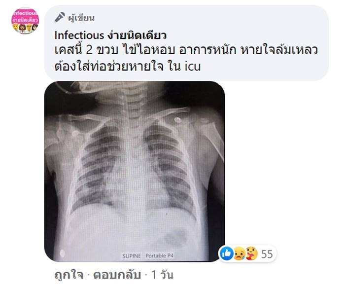 ไวรัสRSV ไวรัสRSV