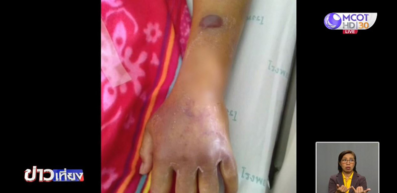 ภาพข่าว แมงมุมพิษ ภาพข่าว แมงมุมพิษ