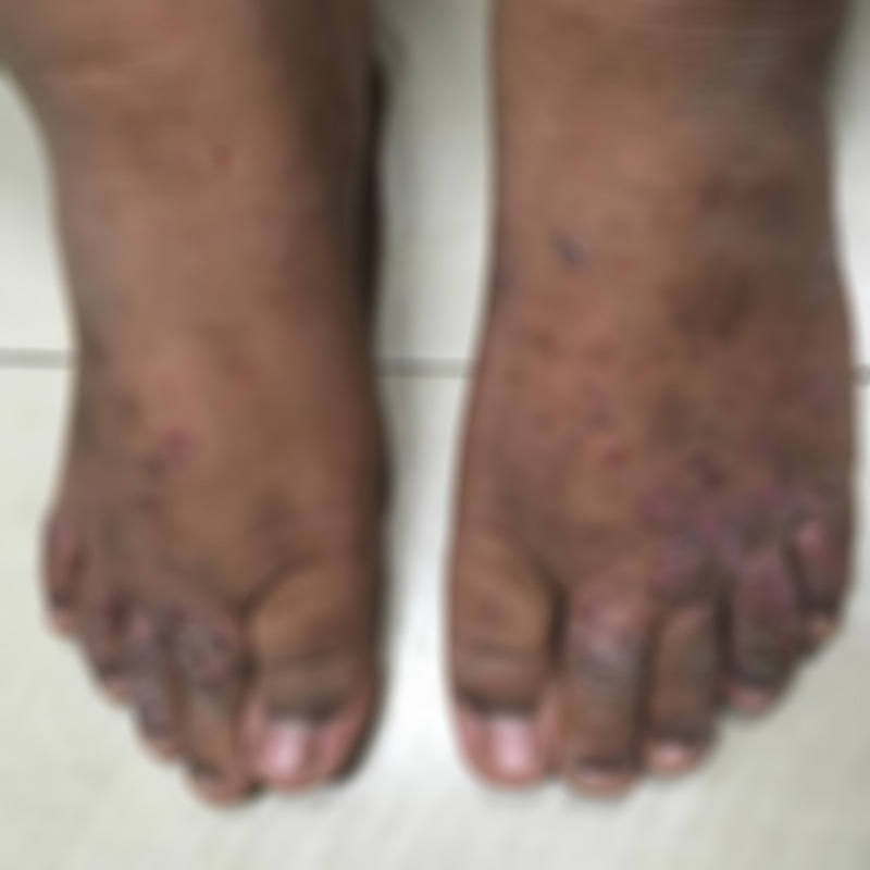 น้ำเหลืองไม่ดี น้ำเหลืองไม่ดี