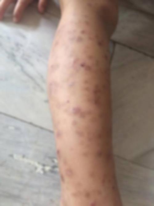 น้ำเหลืองไม่ดี น้ำเหลืองไม่ดี