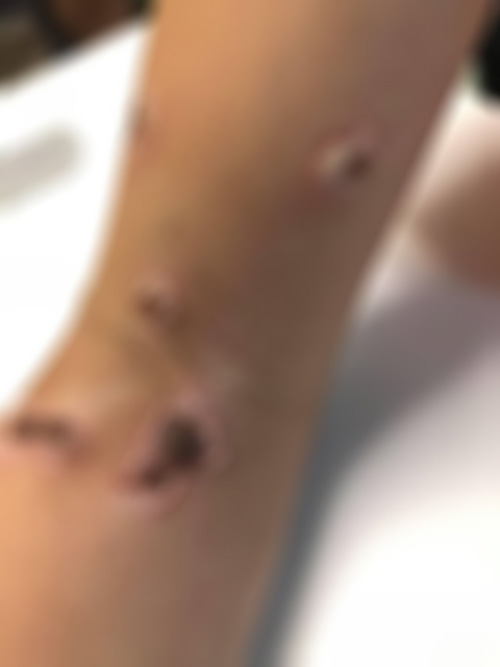 น้ำเหลืองไม่ดี น้ำเหลืองไม่ดี